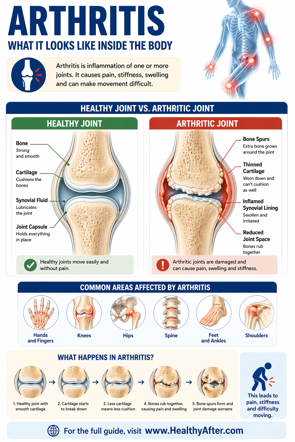 Free Arthritis Education Guide
